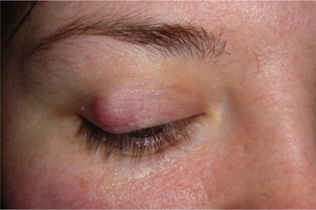 Know The Possible Causes &  Treatments Of Having Bump On Eyelid