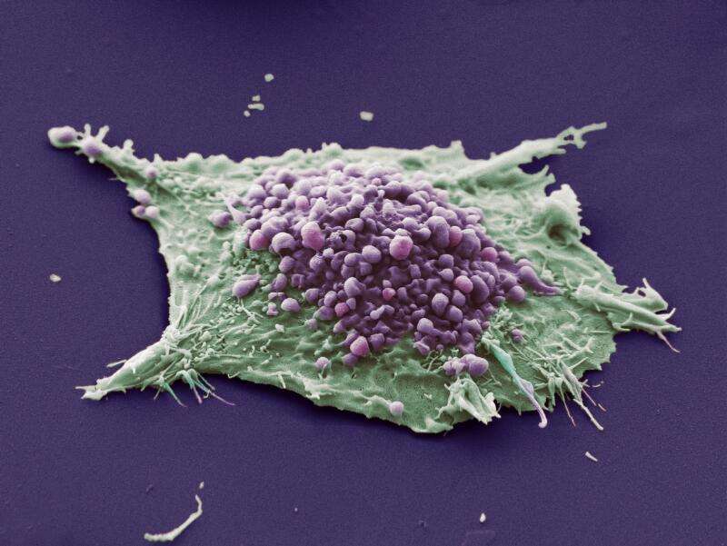Lung cancer cell. This image shows a single cell grown ...