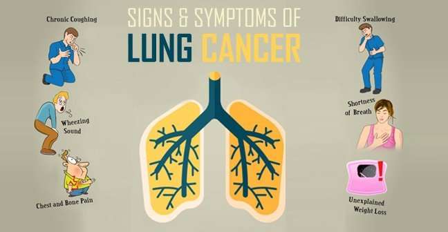 Lung Cancer Symptoms: How Do You Know If You Have Lung ...
