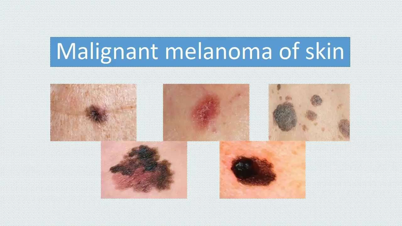 Malignant melanoma: Causes/Risk factors, Symptoms ...