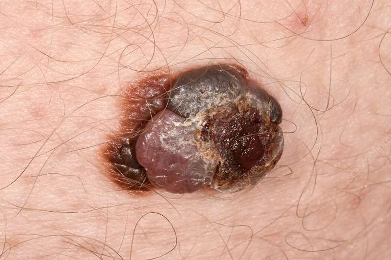 Malignant melanoma skin cancer