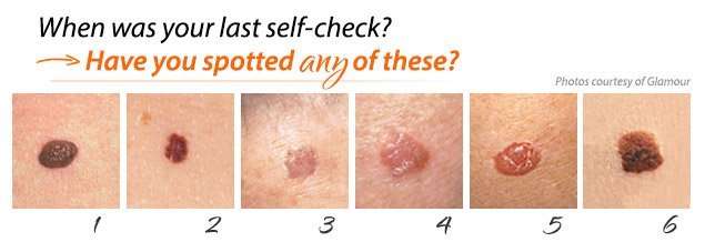 May is Skin Cancer Awareness  Rejuvent Medical Spa and ...