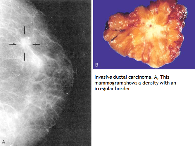 MBBS Medicine (Humanity First): Invasive Carcinomas of Breast.