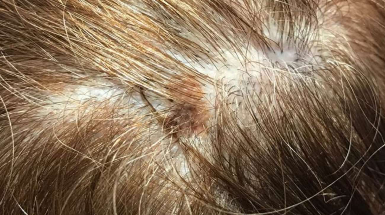 Melanoma on scalp pictures: early stage 1, scalp melanoma ...