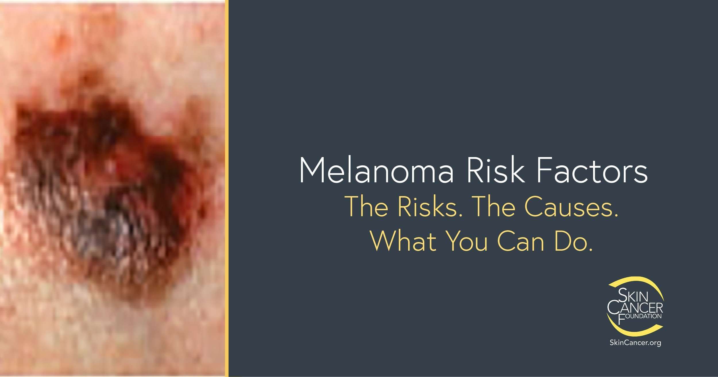 Melanoma Risk Factors