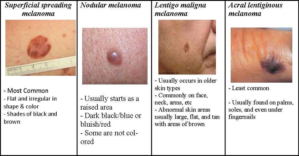 Melanoma / Skin Cancer