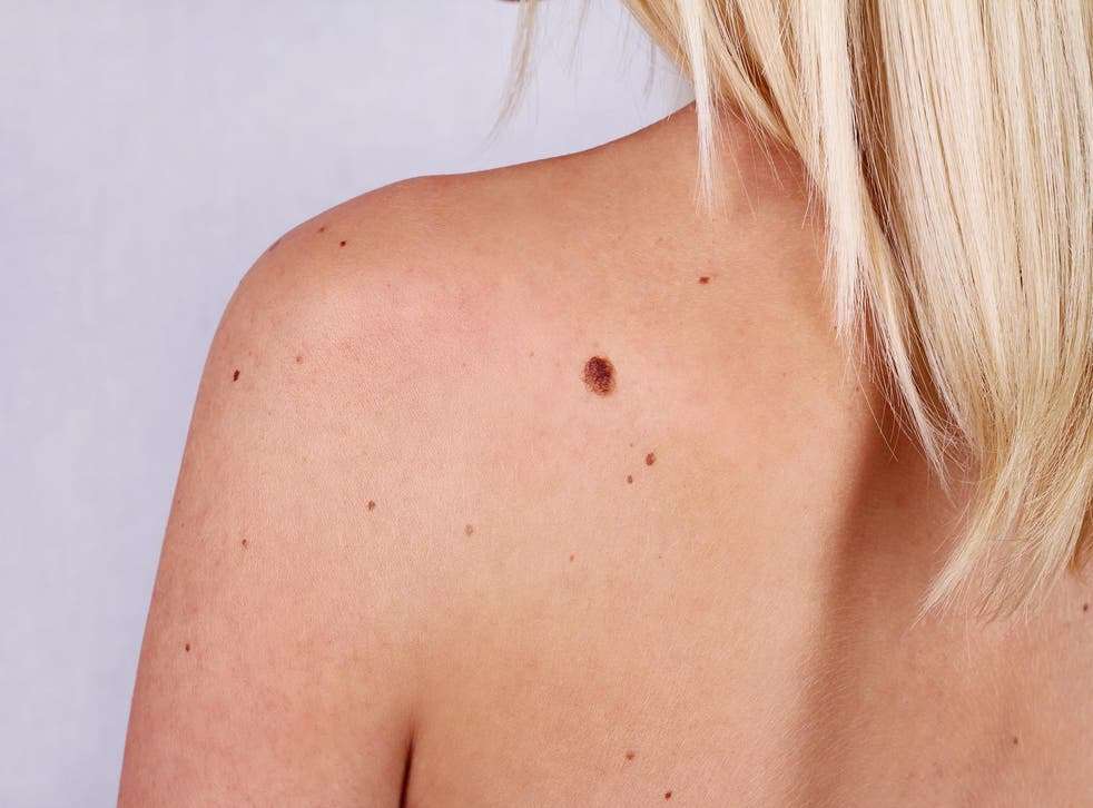 Melanoma skin cancer: What moles to look out for