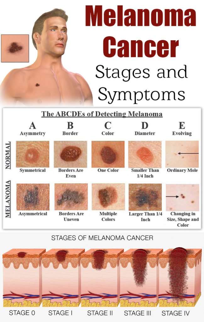 Melanoma Symptoms, Stages &  Metastatic Melanoma Symptoms