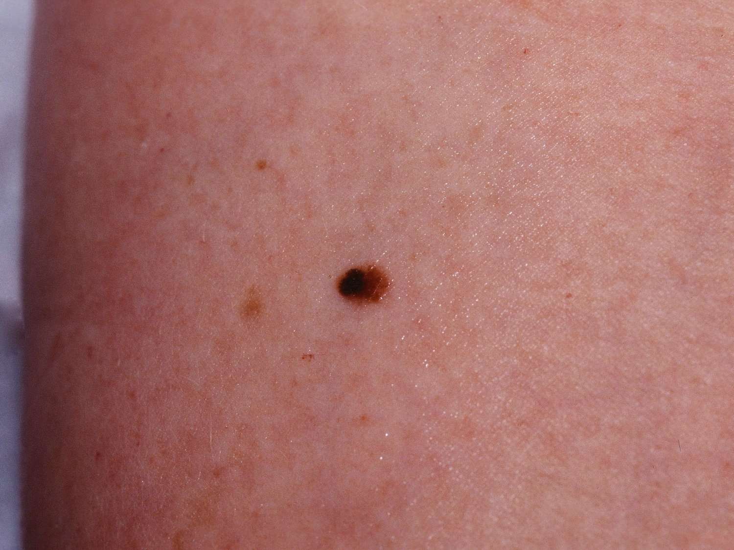 melanomas in situ
