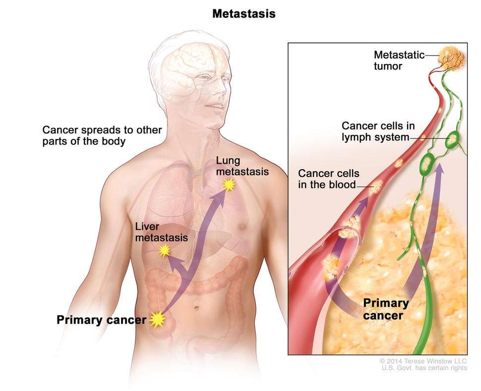 Metastatic Cancer: When Cancer Spreads