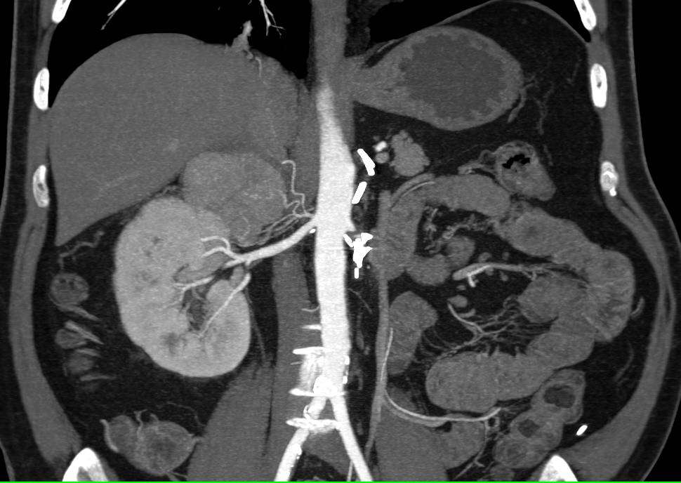 Metastatic Renal Cell Carcinoma to the Contralateral ...