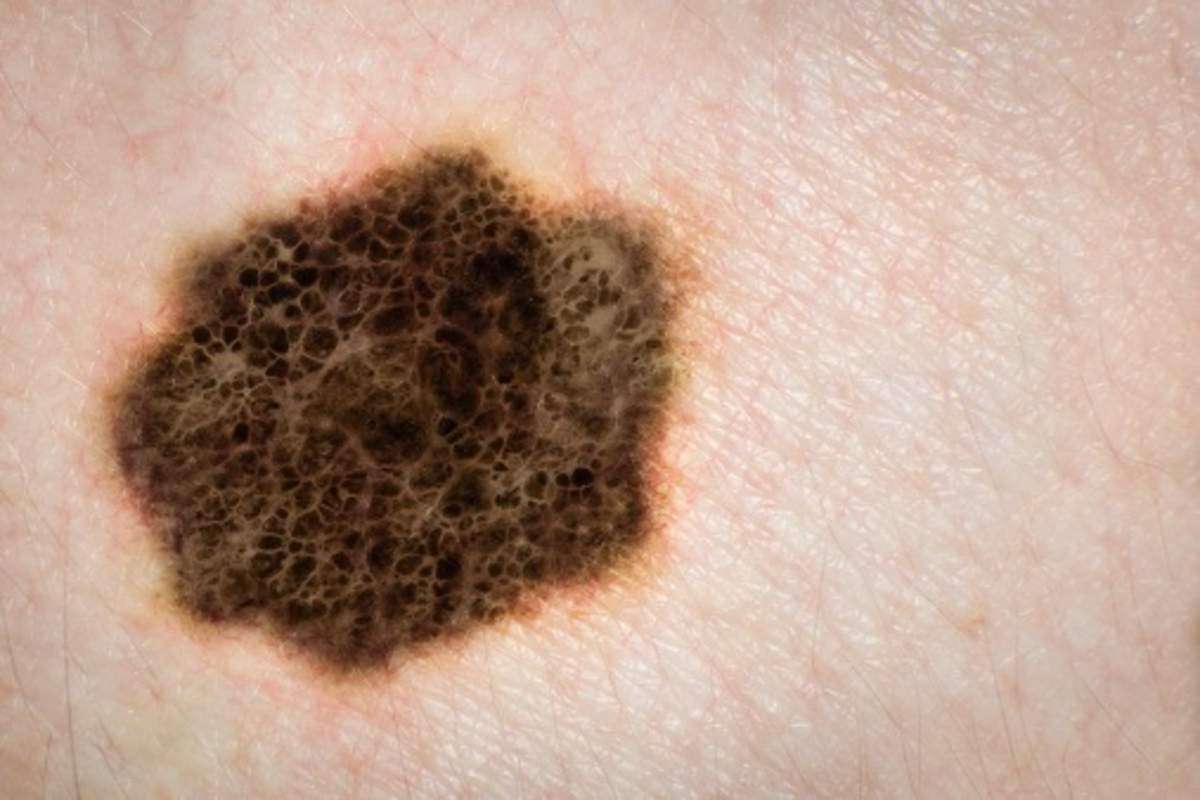 Mole or Melanoma: How to Tell The Difference