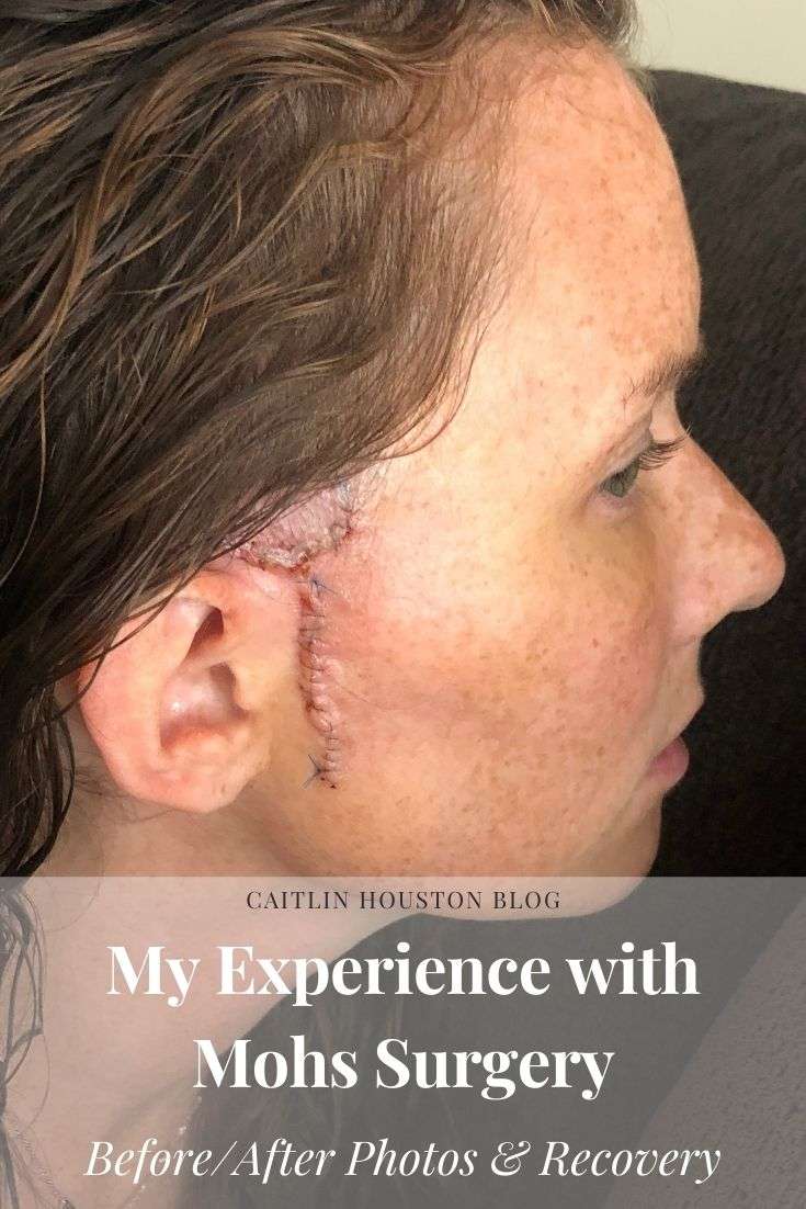 My Mohs Surgery Experience for Basal Cell Carcinoma ...