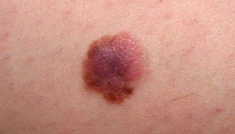 New Findings on how Melanoma Spreads Makes Cure for this Dea