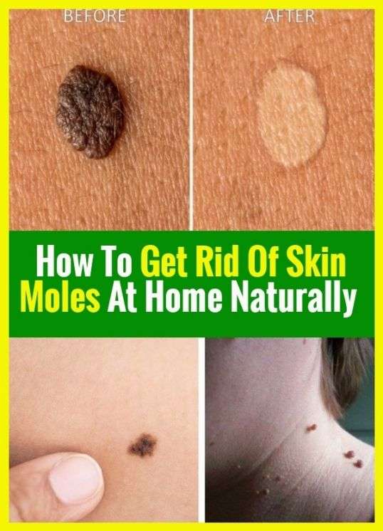 Of course at home how to get rid of your skin moles ...