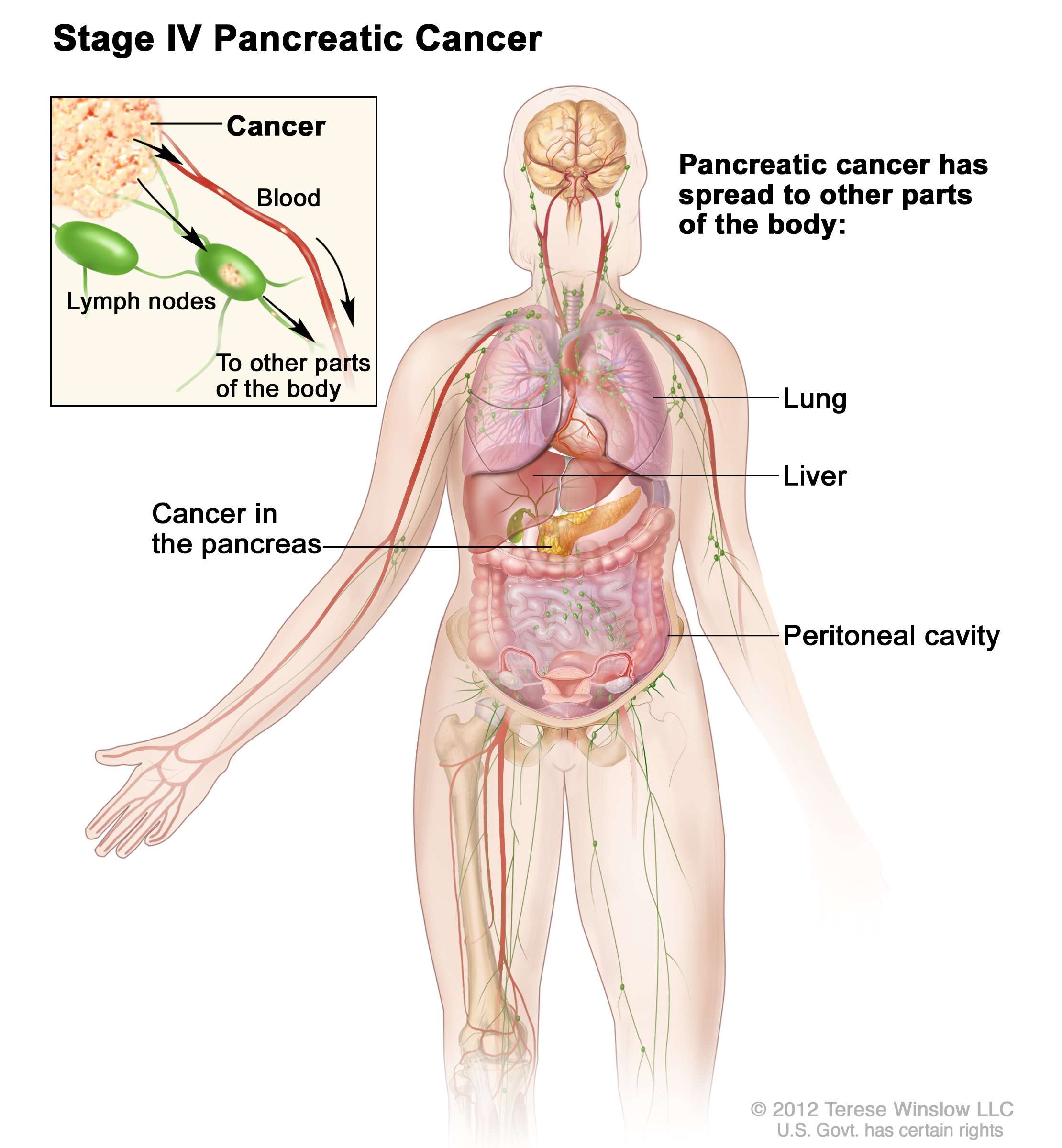 Pancreatic Cancer Treatment (Adult) (PDQ®) (Patients ...