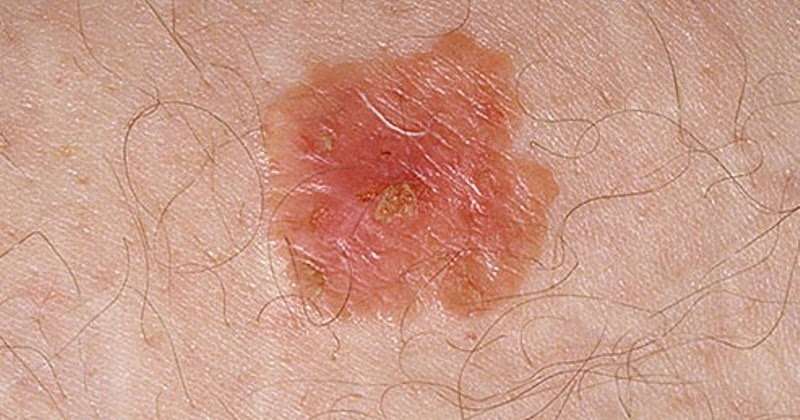Pictures of skin cancer: Common skin cancer