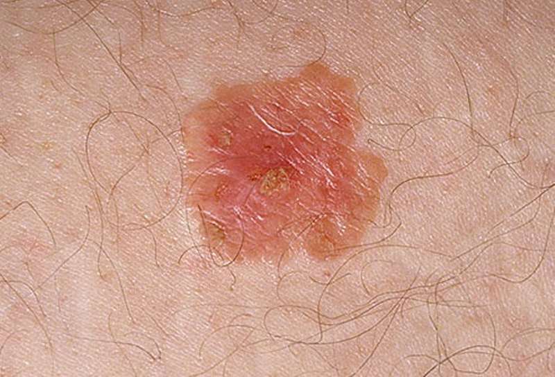 Pictures of skin cancer: White spots skin cancer