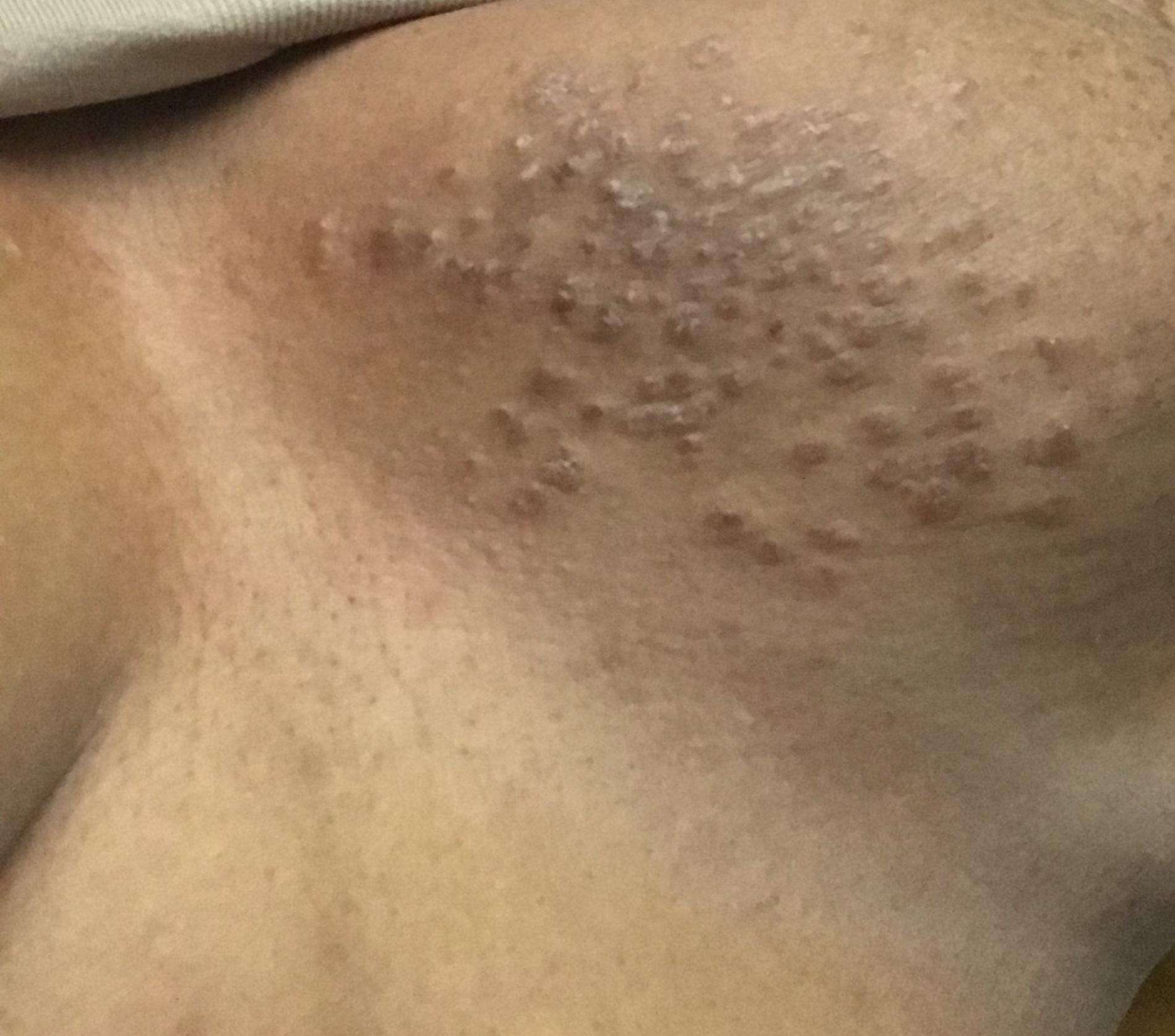 Raised, bumpy itchy rash on chest : Dermatology