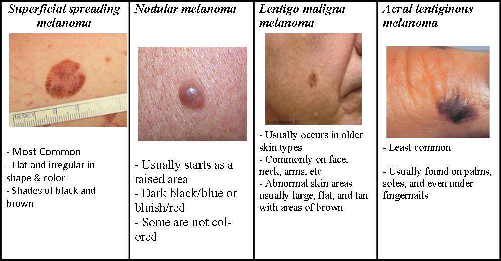 Removal of moles, nevus and warts in children