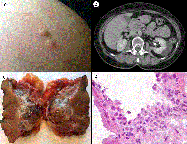 Renal Cell Carcinoma in Hereditary Leyomiomatosis Syndrome ...
