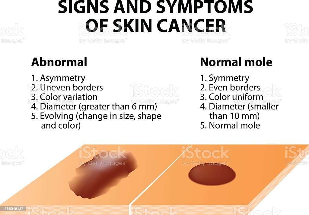 Signs And Symptoms Of Skin Cancer Stock Illustration ...