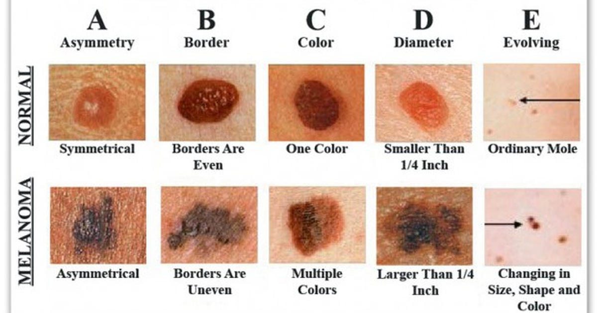 Simple Ways To Spot Skin Cancer Before It Becomes A Life ...