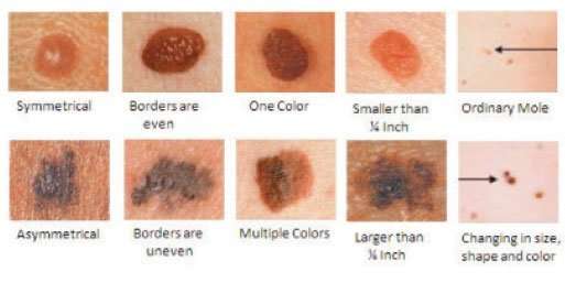 Skin Cancer 101: A review of the 3 most common skin cancers
