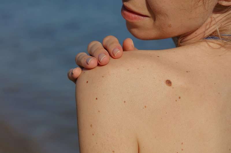 Skin cancer and moles: Am I at risk?