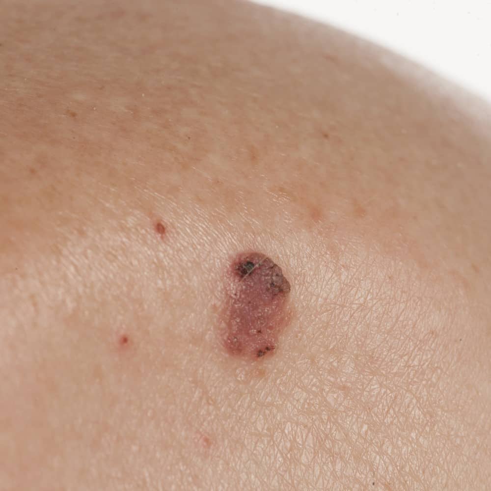 Skin Cancer and Surgery