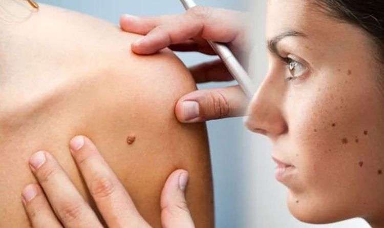 Skin cancer: Does your mole look like this? Pictures ...