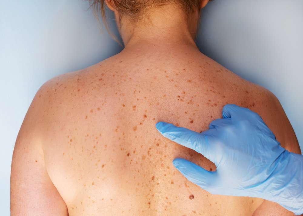 Skin cancer images on back NISHIOHMIYA