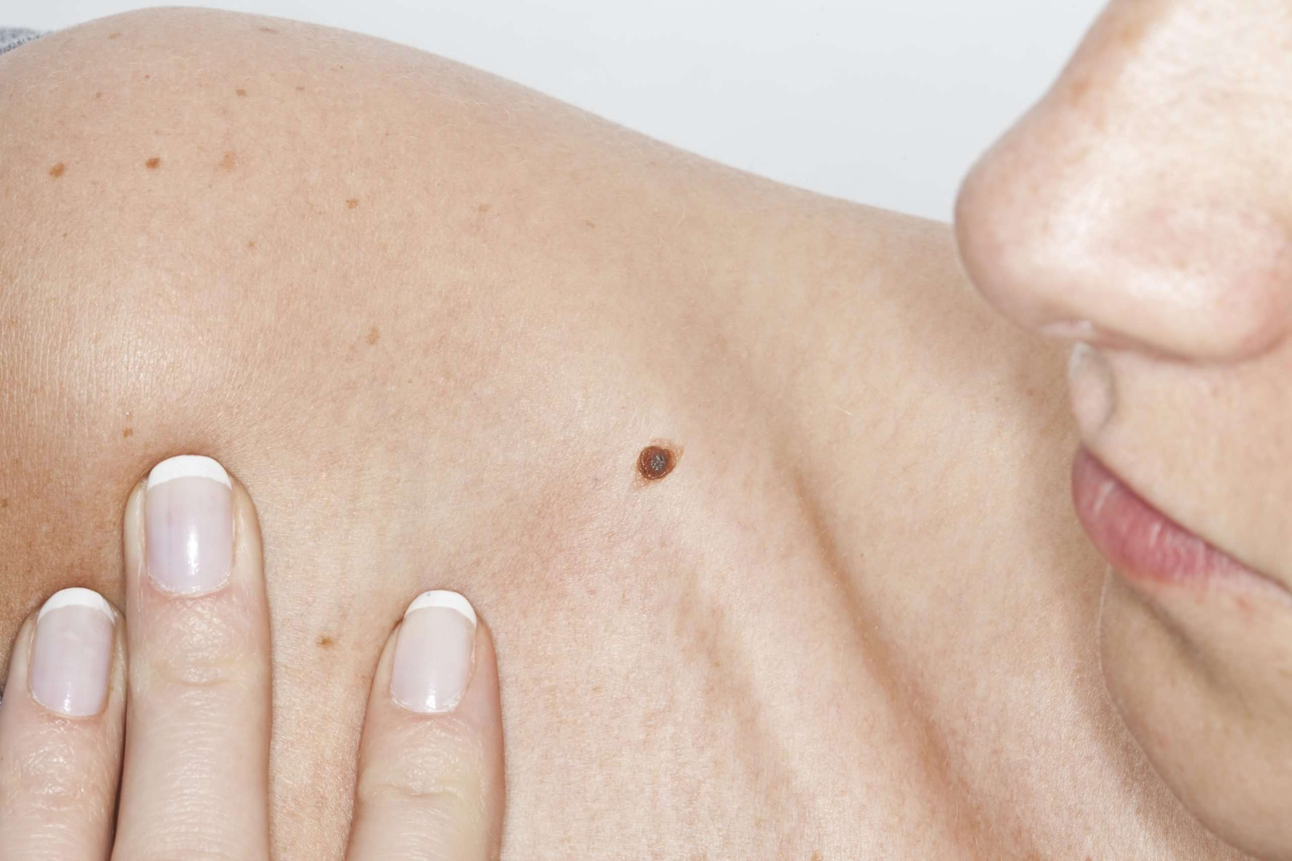 Skin Cancer &  Moles: What to Look out for and When to See ...