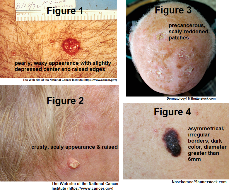 Skin Cancer NCLEX Questions