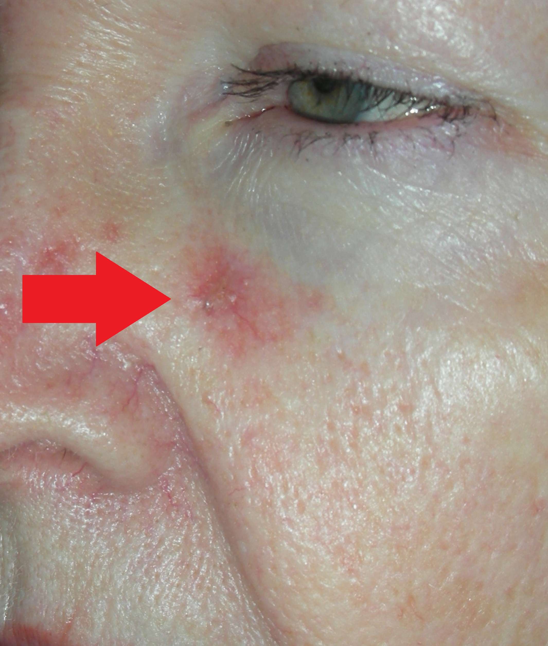 Skin cancer Nose and Local Flap Repair