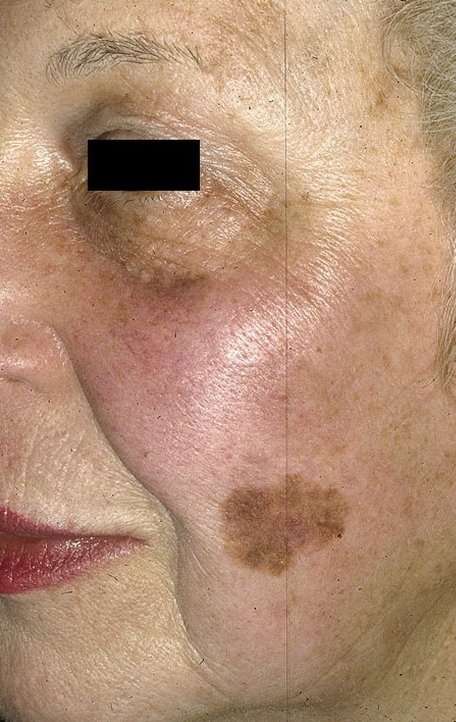 Skin Cancer on Face Pictures â 33 Photos &  Images ...