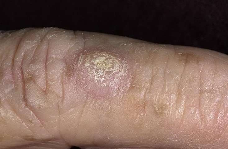 Skin Cancer on Hands Pictures  16 Photos &  Images ...