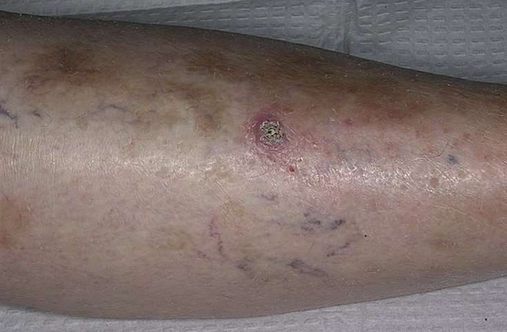 Skin Cancer on Leg Pictures  22 Photos &  Images ...