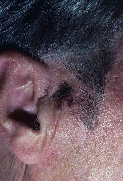 Skin Cancer on Scalp Pictures  20 Photos &  Images ...