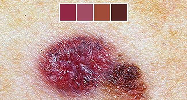 Skin Cancer Photos: What Skin Cancer &  Precancerous ...