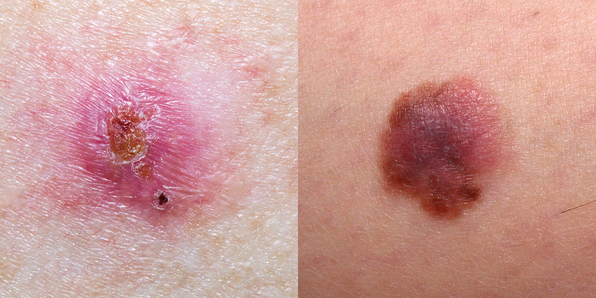 Skin Cancer Pictures
