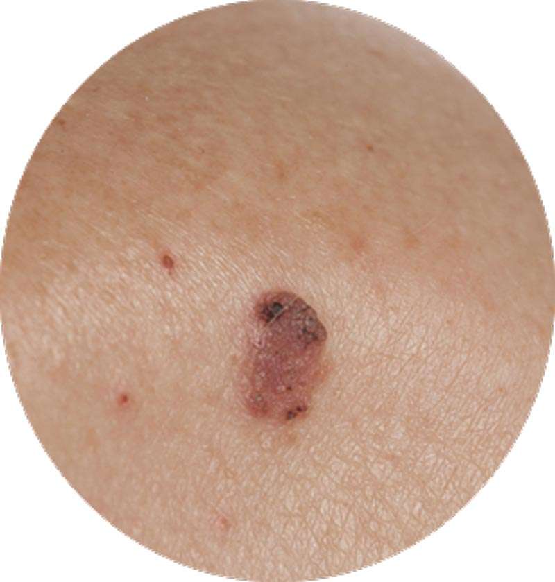 Skin Cancer Removal In Perth  Ethicos Institute