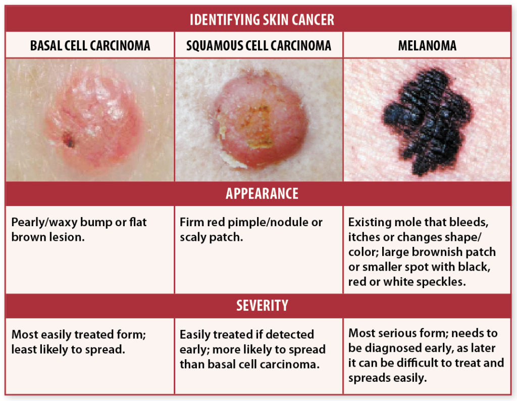 Skin Cancer Signs? Self