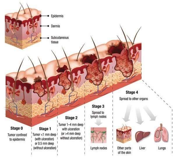 Skin cancer stages (source: teleskin.org)