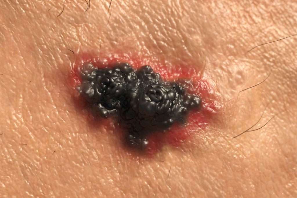 Skin Cancer Symptoms You Should Check For Now