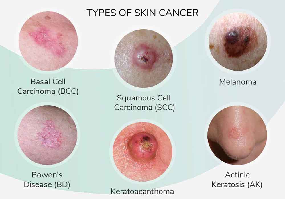 Skin Cancer  Types, Images, Symptoms, Rash, Spots, Bumps ...