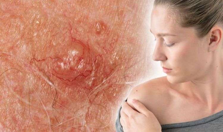 Skin cancer warning: The one sign other than a mole you ...