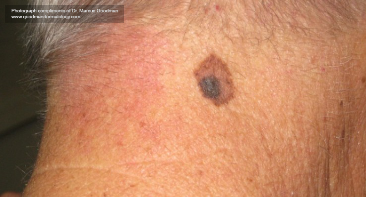 Skin Cancer: What Does Skin Cancer Feel Like