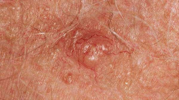 Skin Cancers Definition Cure &  Prevention