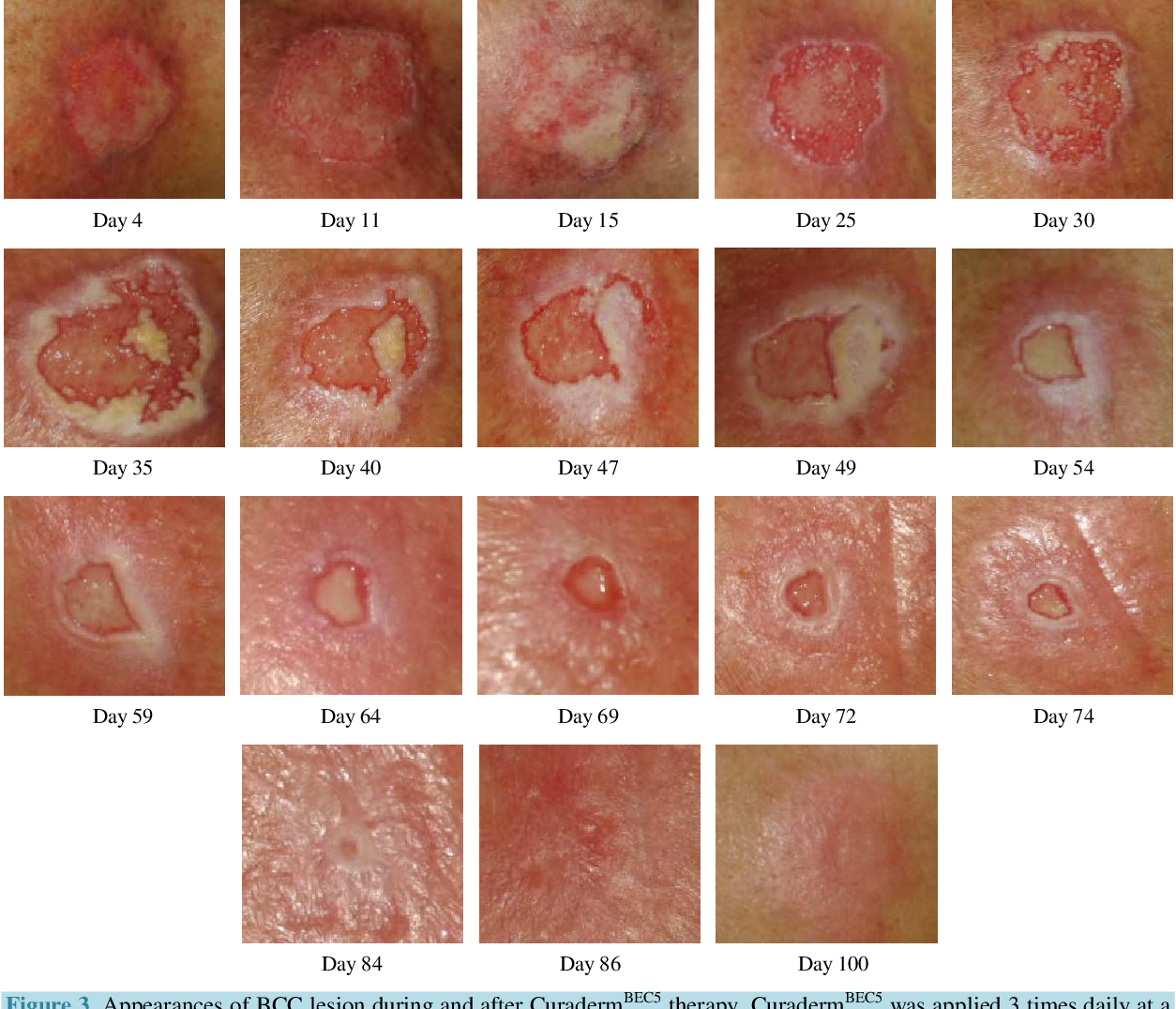 Skin Disease Cancer Treatment / Skin Cancer &  Melanoma ...